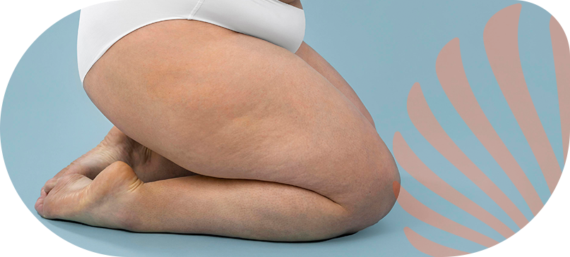 evelyn-boliani-saude-vascular-lipedema